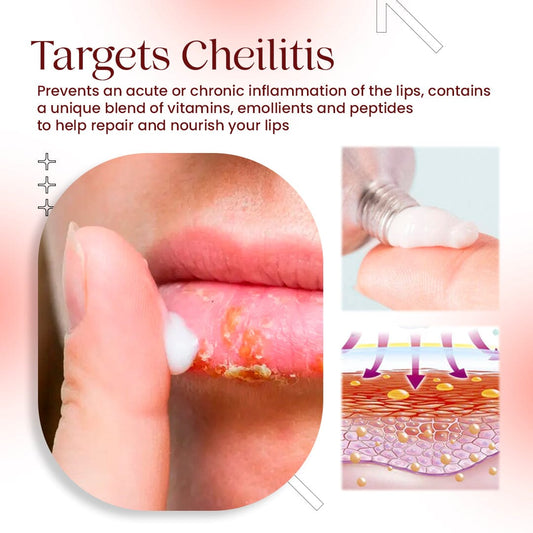 Cold Sores Lip Cheilitis Treatment Cream